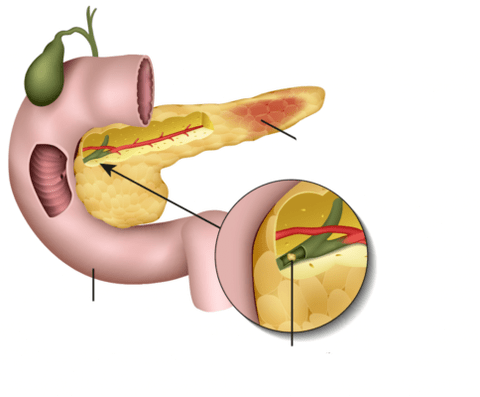 La pancreatitis es una inflamación del páncreas. 